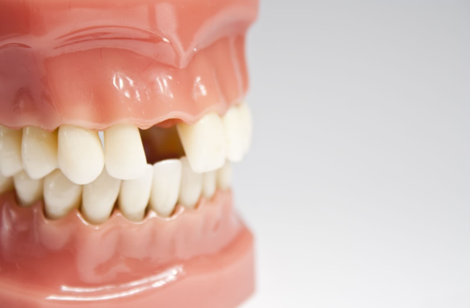 Close-up of a dental mold showing a missing tooth