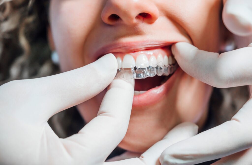 A hand wearing white medical gloves inserting an Invisalign clear aligner into an orthodontic patient's mouth.