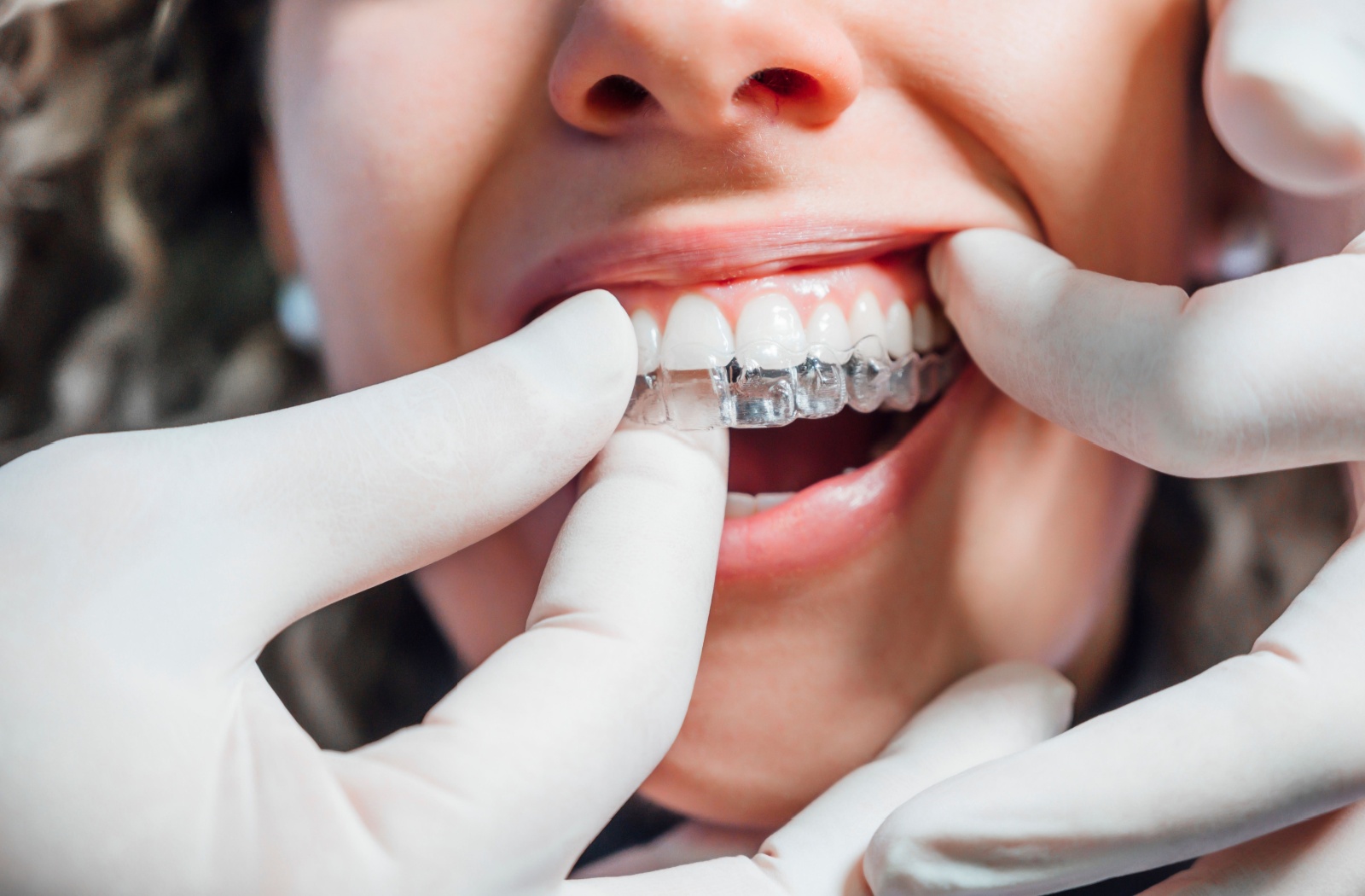 A hand wearing white medical gloves inserting an Invisalign clear aligner into an orthodontic patient's mouth.
